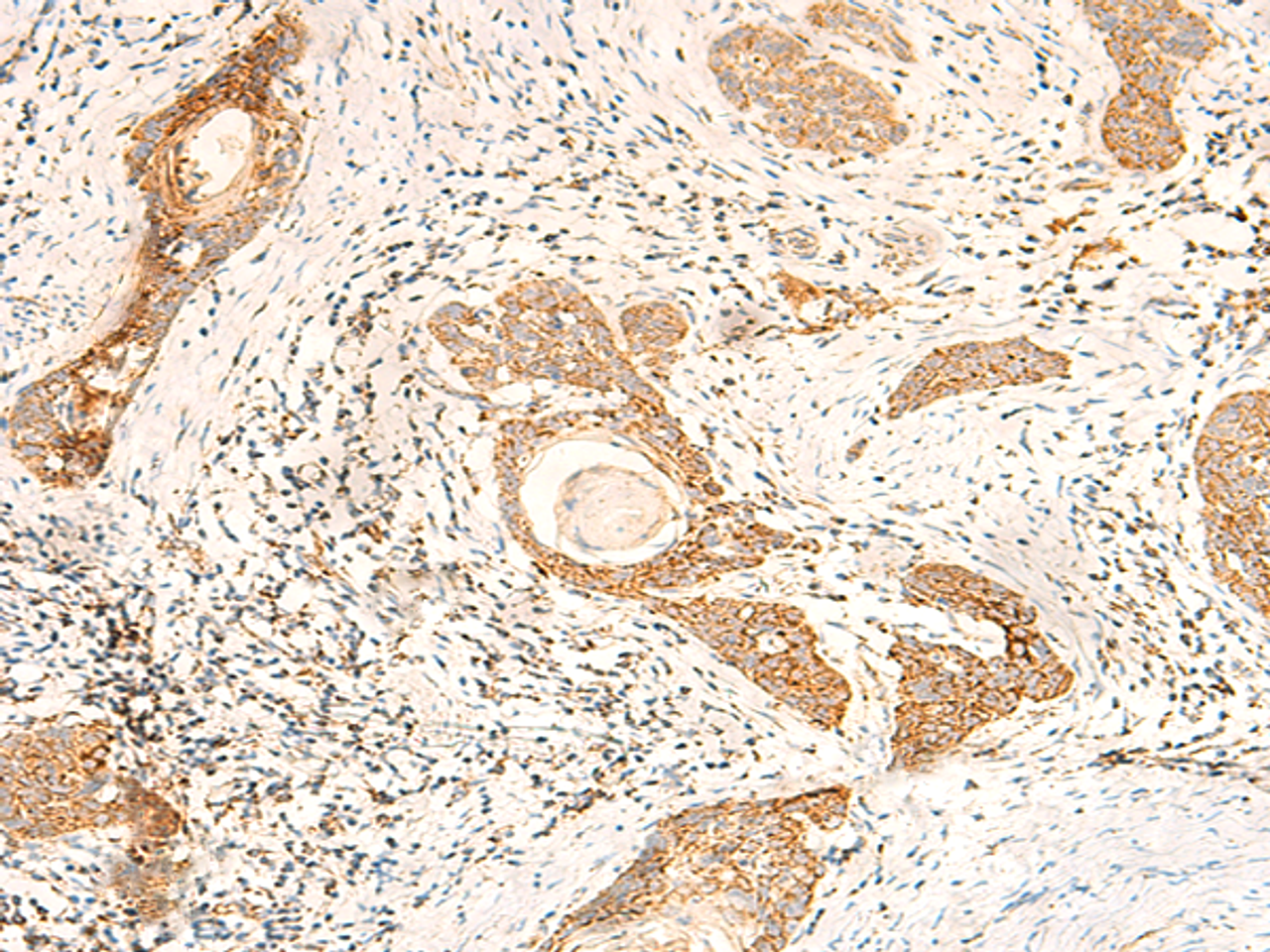 Immunohistochemistry of paraffin-embedded Human esophagus cancer tissue  using MT-CO2 Polyclonal Antibody at dilution of 1:60(×200)