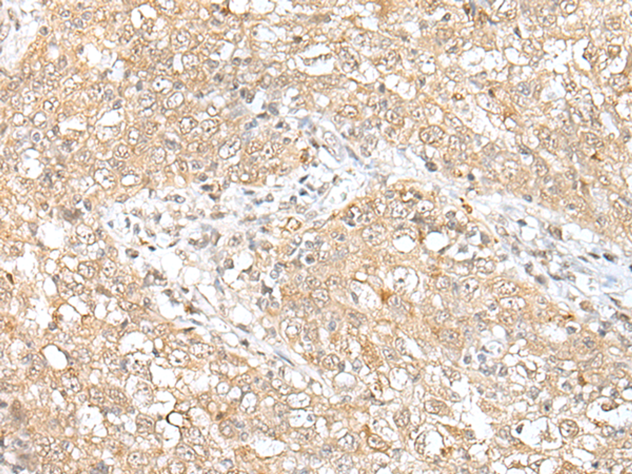 Immunohistochemistry of paraffin-embedded Human esophagus cancer tissue  using CHRNB2 Polyclonal Antibody at dilution of 1:50(×200)