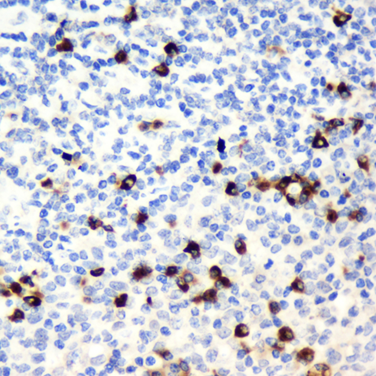 Immunohistochemistry analysis of paraffin-embedded Human tonsil  using CD19 Polyclonal Antibody at dilution of 1:300.