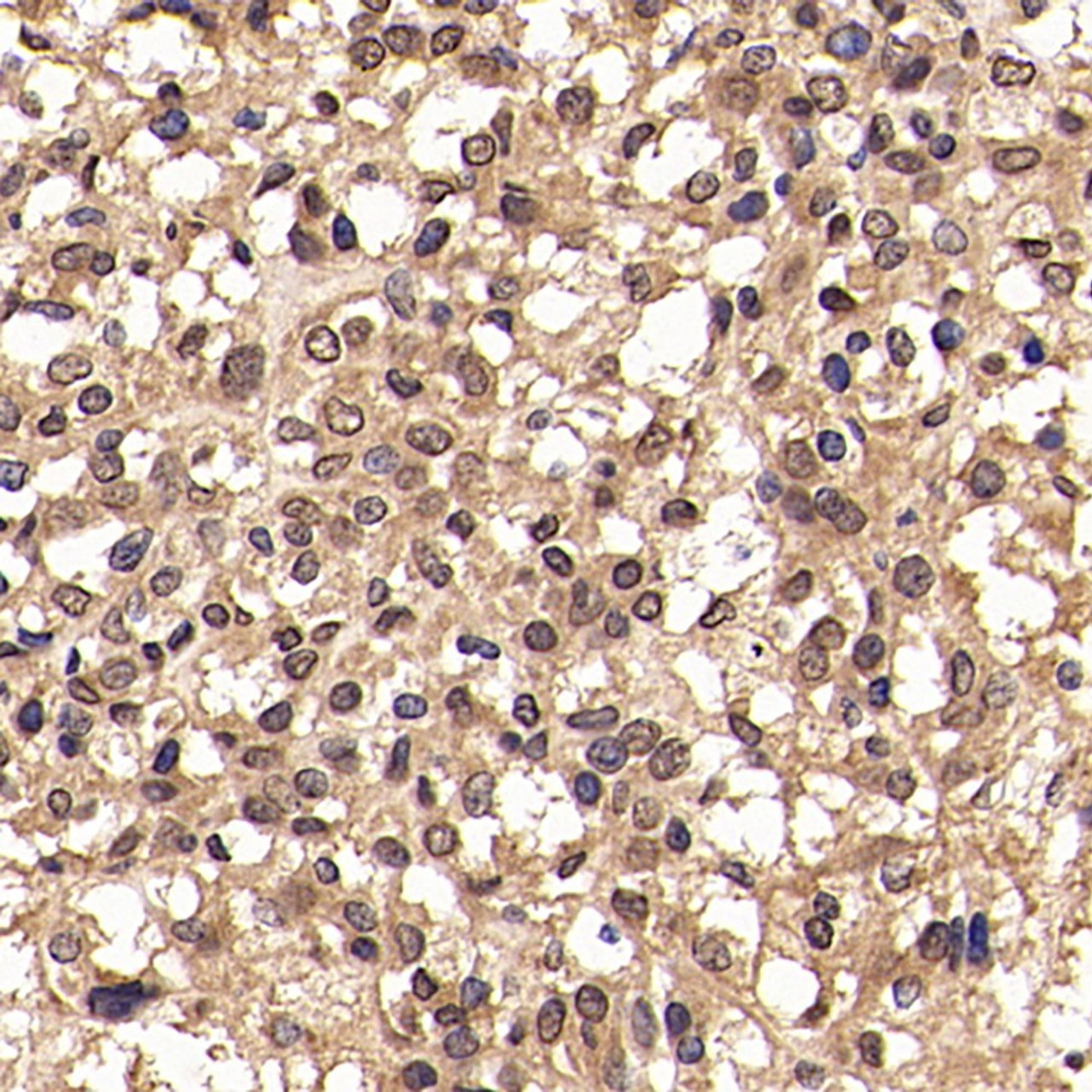 Immunohistochemistry analysis of paraffin-embedded human liver cancer   using JUN Polyclonal Antibody at dilution of 1:500.