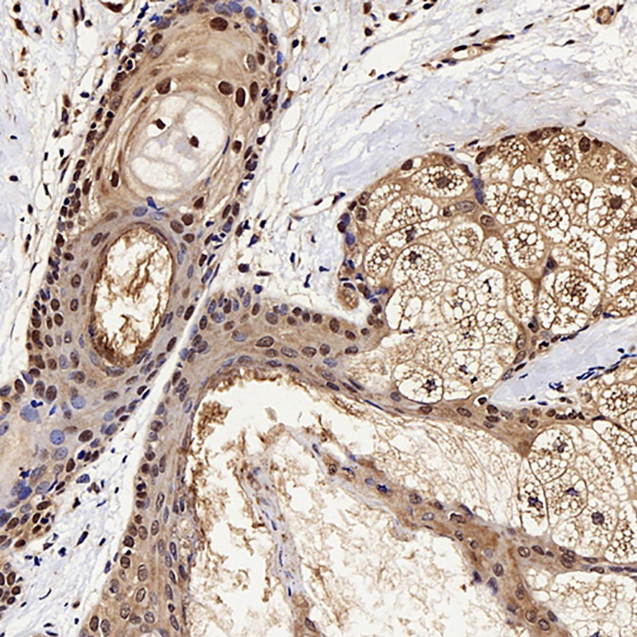 Immunohistochemistry analysis of paraffin-embedded human ovary cancer  using GSK3 beta Polyclonal Antibody at dilution of 1:300.