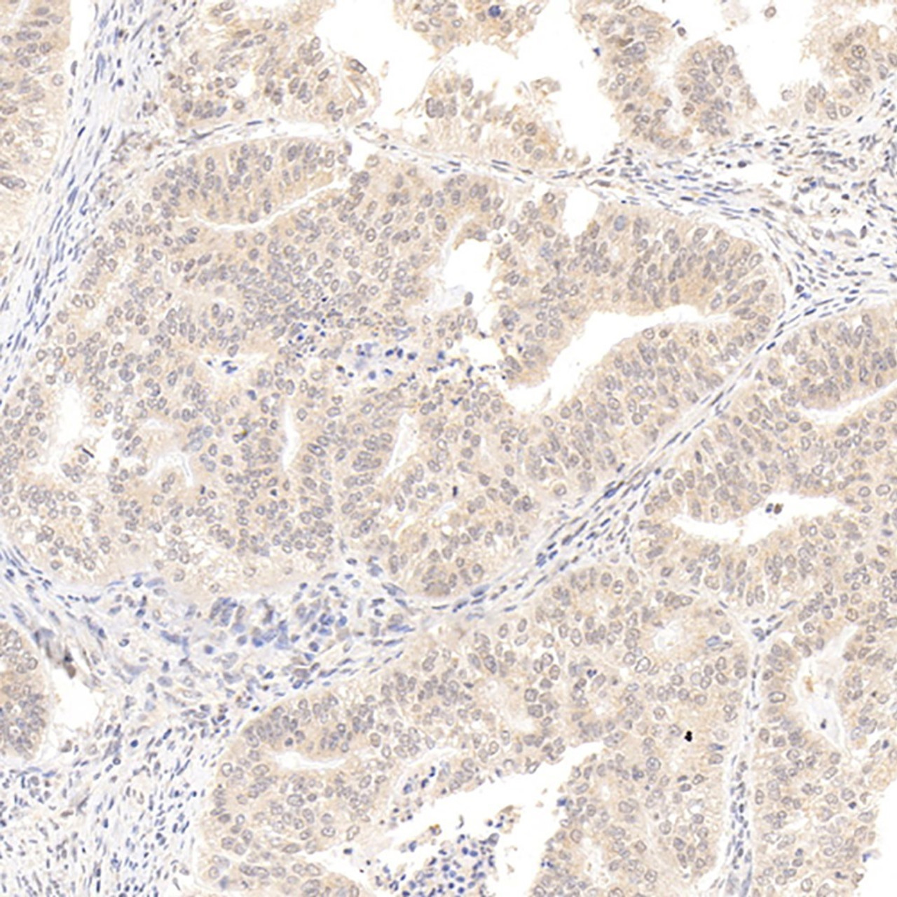 Immunohistochemistry analysis of paraffin-embedded human Endometrial cancer  using ATF6 Polyclonal Antibody at dilution of 1:400.