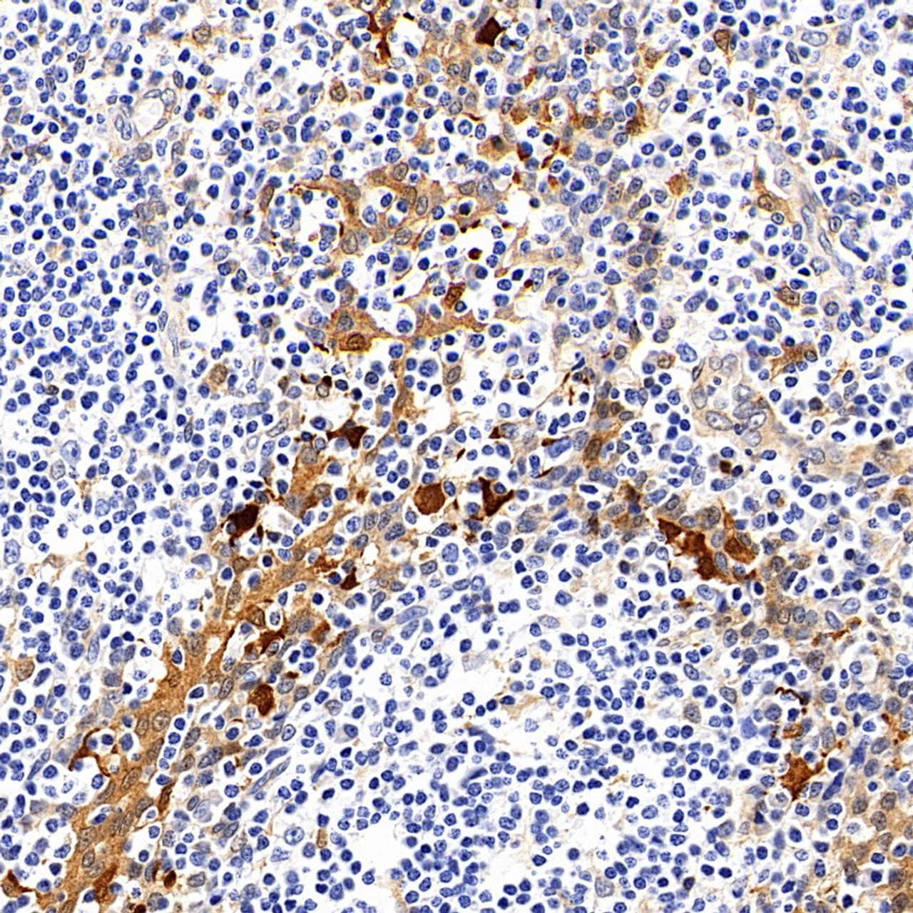 Immunohistochemistry analysis of paraffin-embedded human tonsil tissue  using Galectin 3 Monoclonal Antibody at dilution of 1:400.