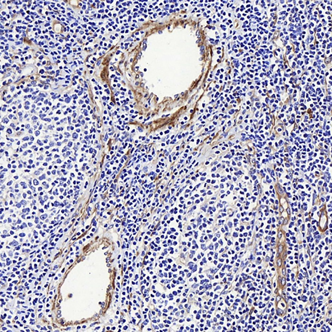 Immunohistochemistry analysis of paraffin-embedded human Lymphoma  using LDLR Polyclonal Antibody at dilution of 1:300.