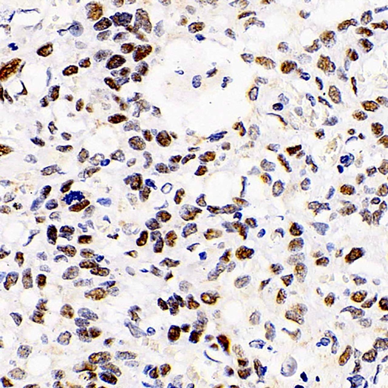 Immunohistochemistry analysis of paraffin-embedded human lung cancer  using HDAC2 Polyclonal Antibody at dilution of 1:1000.