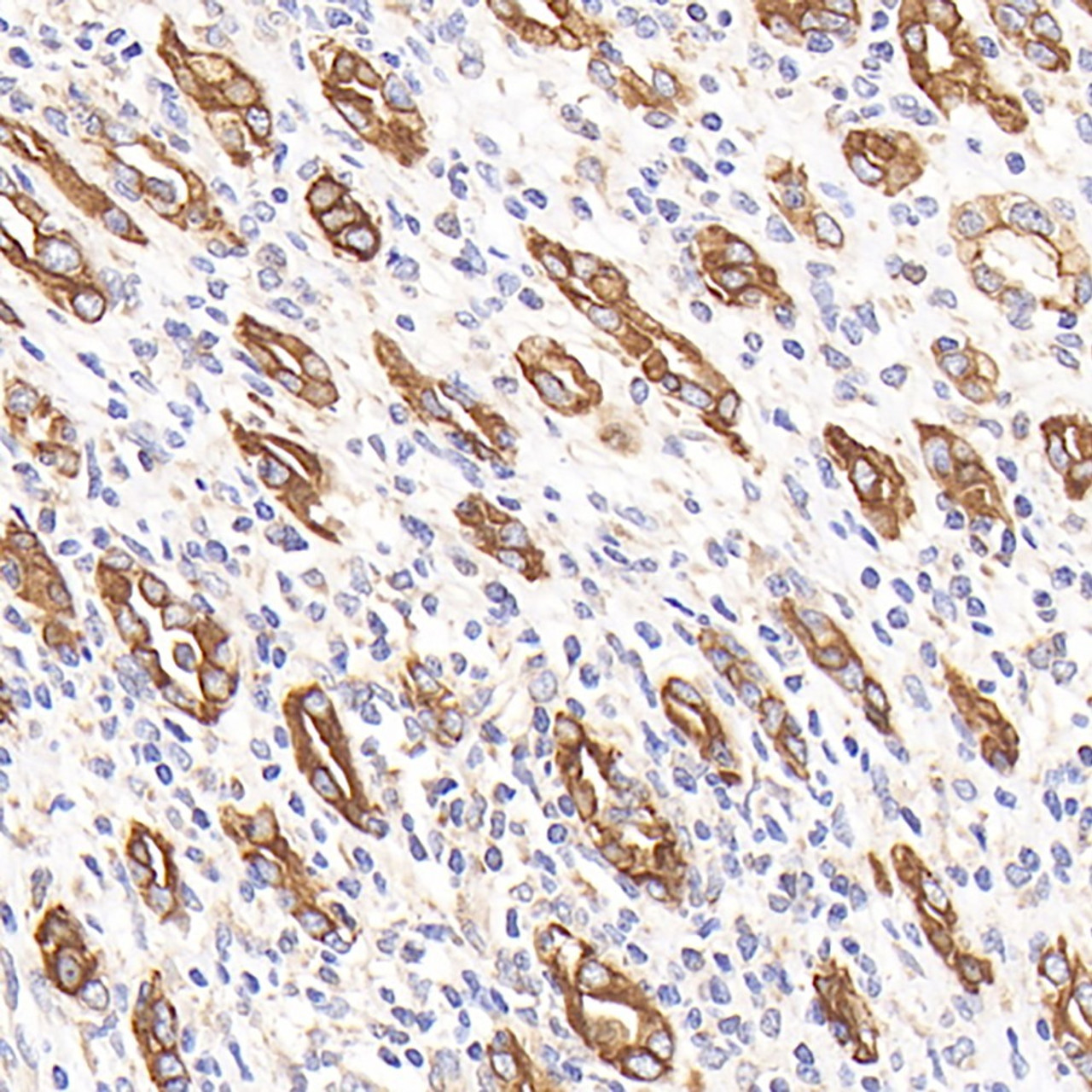 Immunohistochemistry analysis of paraffin-embedded human stomach cancer  using CK-7 Monoclonal Antibody at dilution of 1:300.