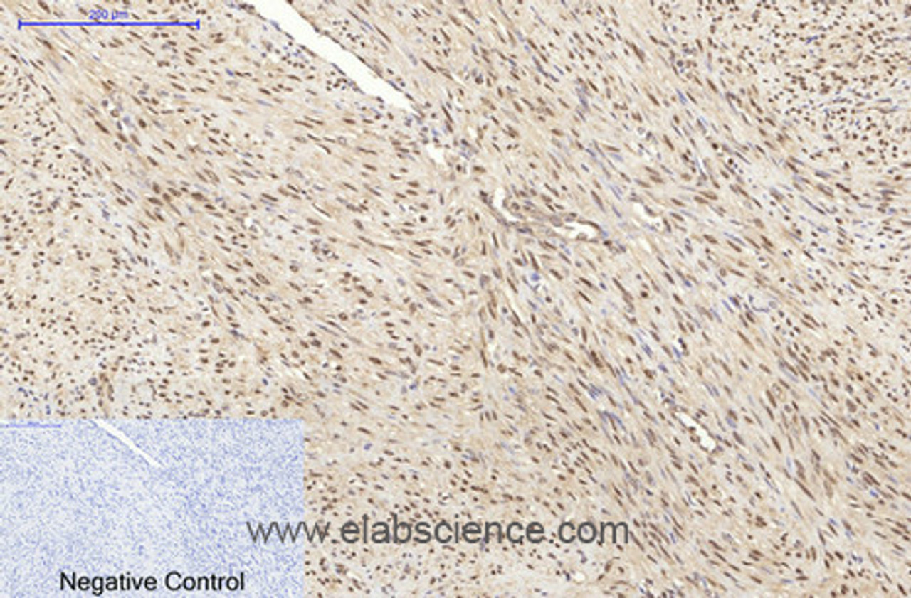 Immunohistochemistry of paraffin-embedded Human uterus cancer tissue using HSP70 Monoclonal Antibody at dilution of 1:200.