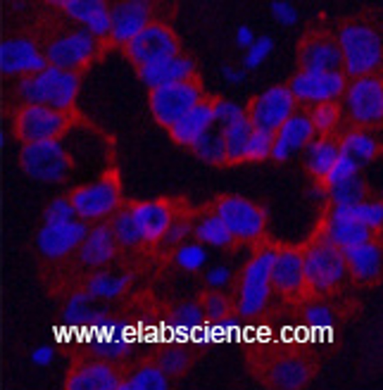 Immunofluorescence analysis of Human liver cancer tissue using CK-16 Monoclonal Antibody at dilution of 1:200.