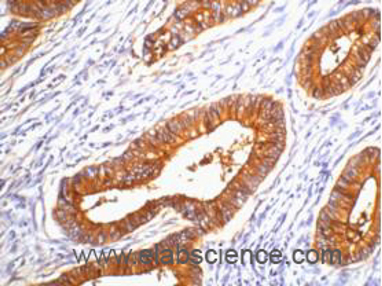 Immunohistochemistry of paraffin-embedded Human colon cancer tissue using CD66e Monoclonal Antibody at dilution of 1:200.