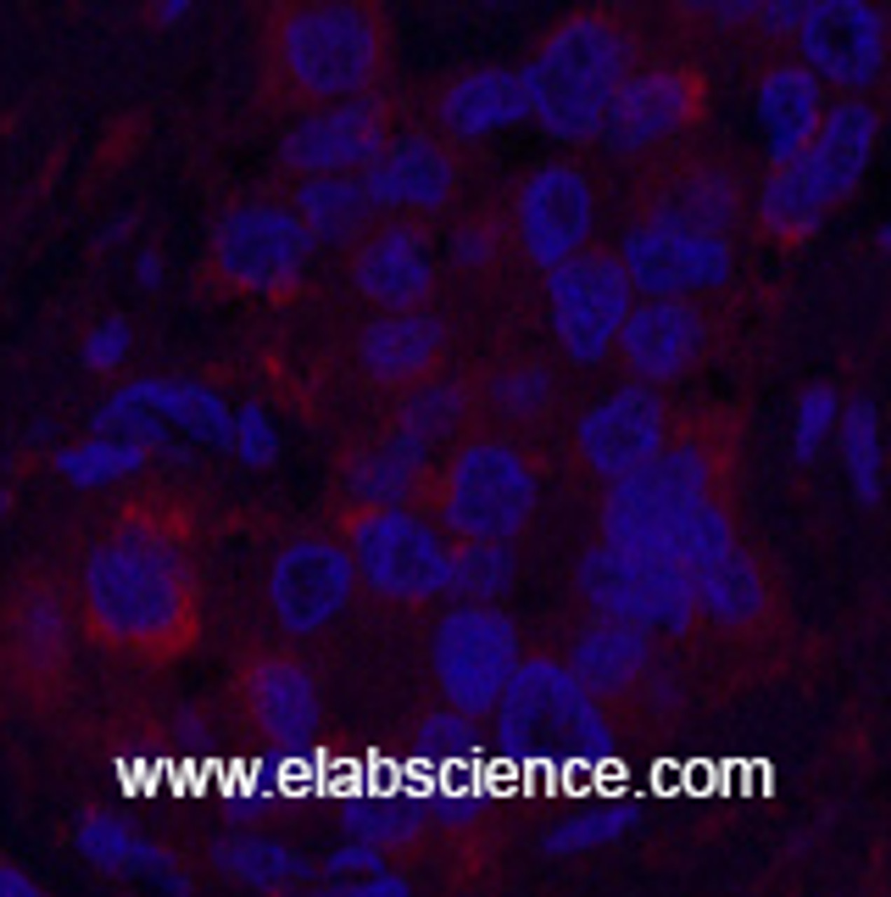 Immunofluorescence analysis of Human liver cancer tissue using FH Monoclonal Antibody at dilution of 1:200.