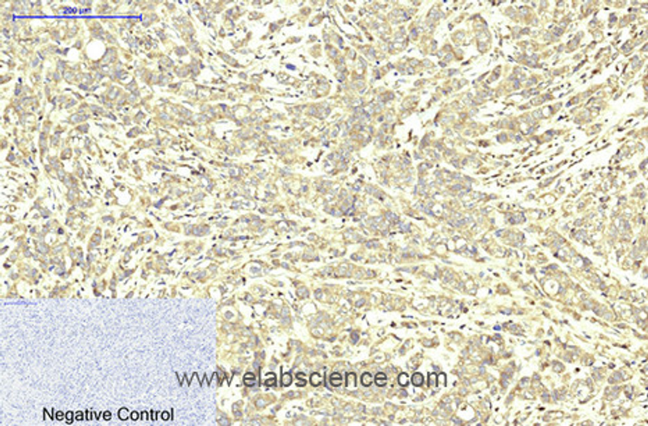 Immunohistochemistry of paraffin-embedded Human breast cancer tissue using ABCB5 Monoclonal Antibody at dilution of 1:200.
