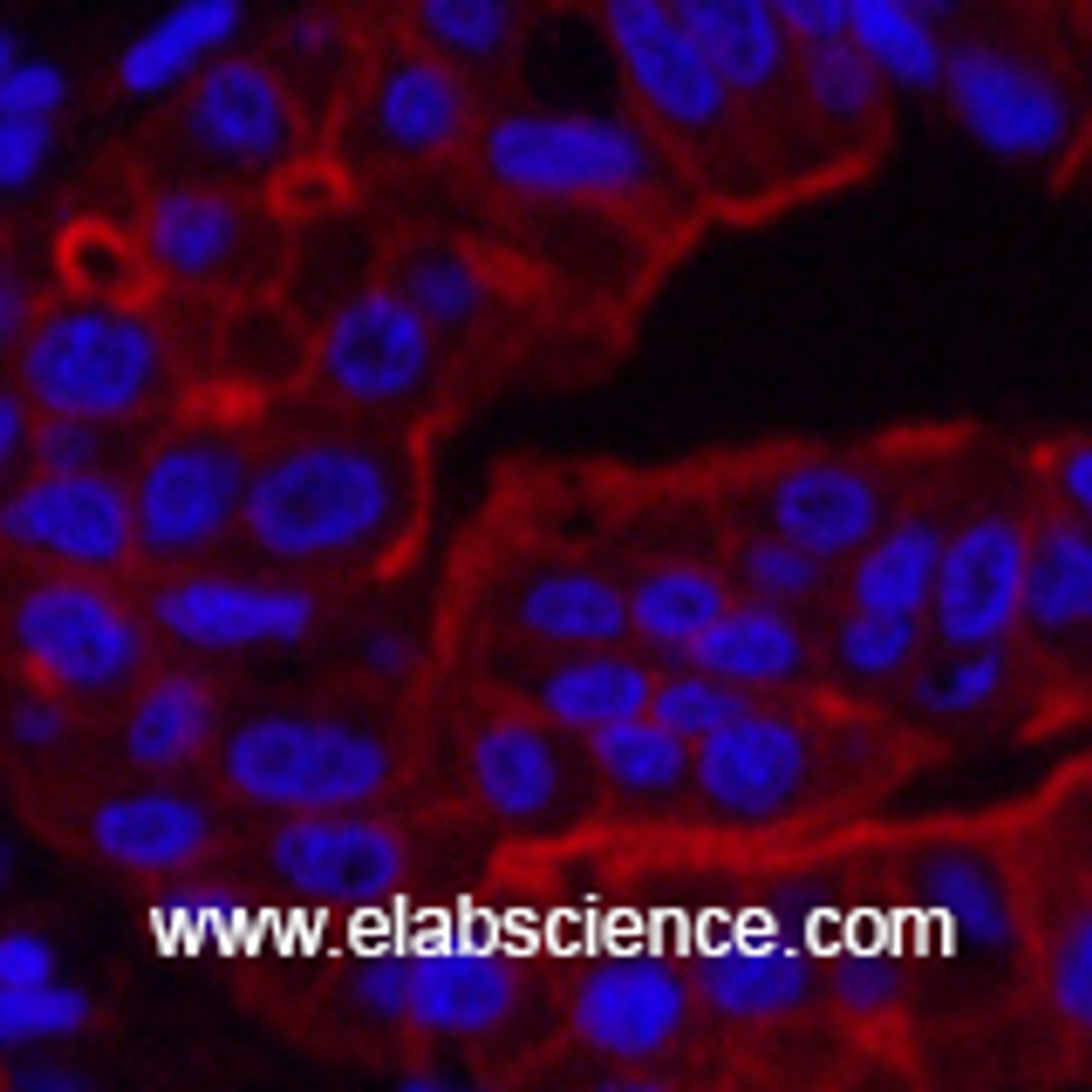 Immunofluorescence analysis of Human liver cancer tissue using ABCB5 Monoclonal Antibody at dilution of 1:200.
