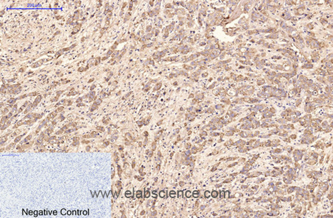Immunohistochemistry of paraffin-embedded Human breast cancer tissue using AFP Monoclonal Antibody at dilution of 1:200.