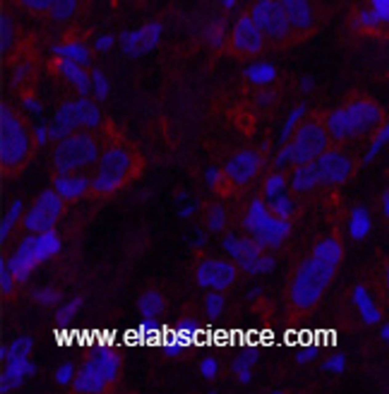 Immunofluorescence analysis of Human breast cancer tissue using AFP Monoclonal Antibody at dilution of 1:200.