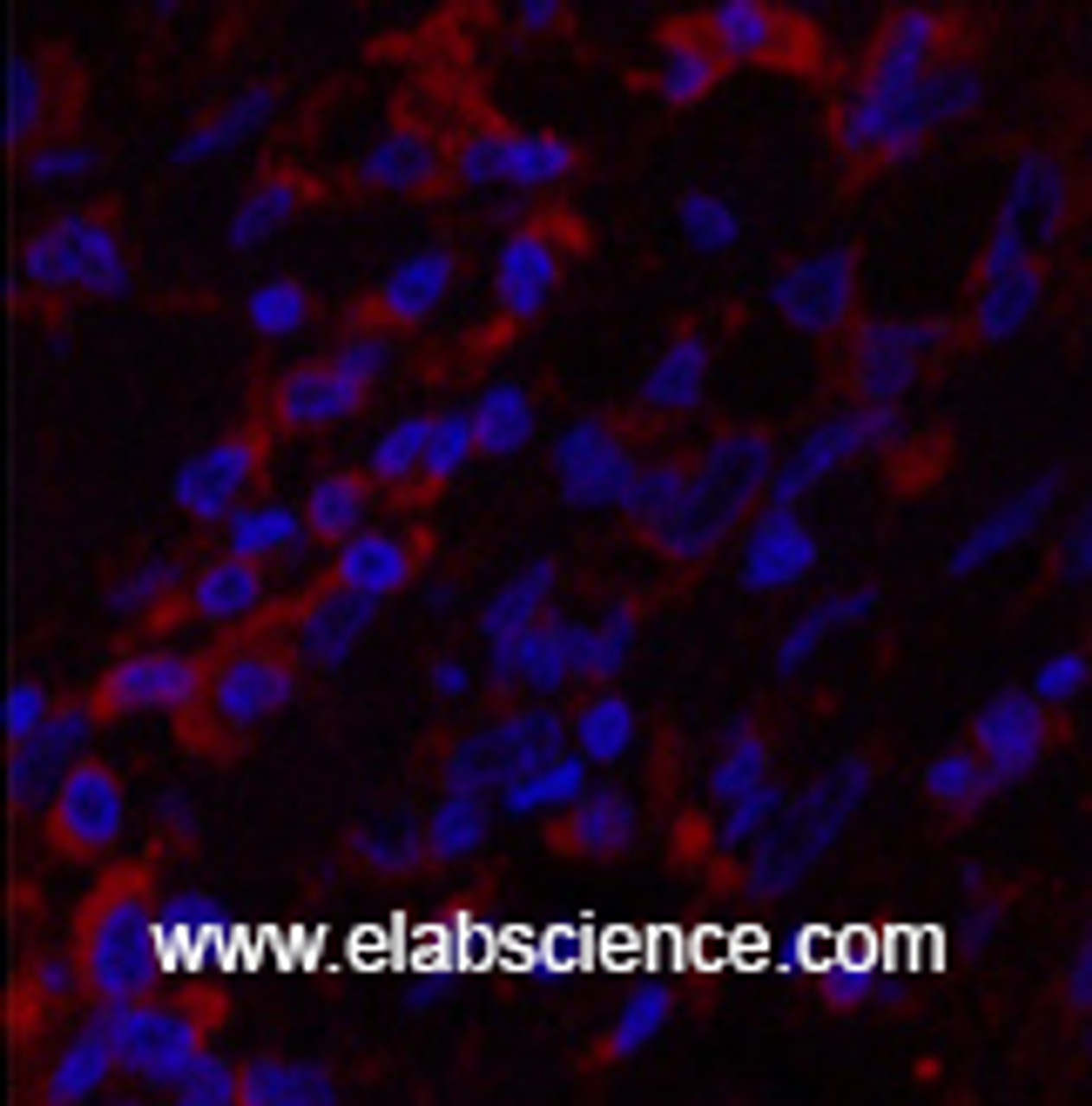 Immunofluorescence analysis of Human breast cancer tissue using CK-6A/B/C Monoclonal Antibody at dilution of 1:200.