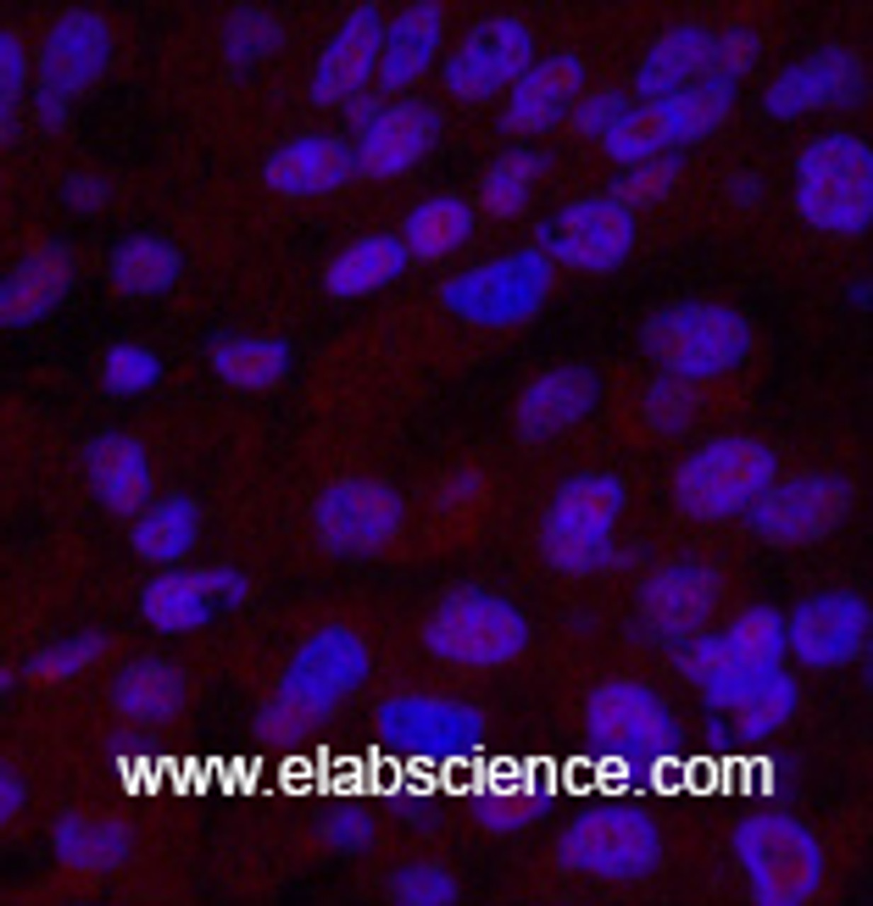 Immunofluorescence analysis of Human liver cancer tissue using XRCC4 Monoclonal Antibody at dilution of 1:200.