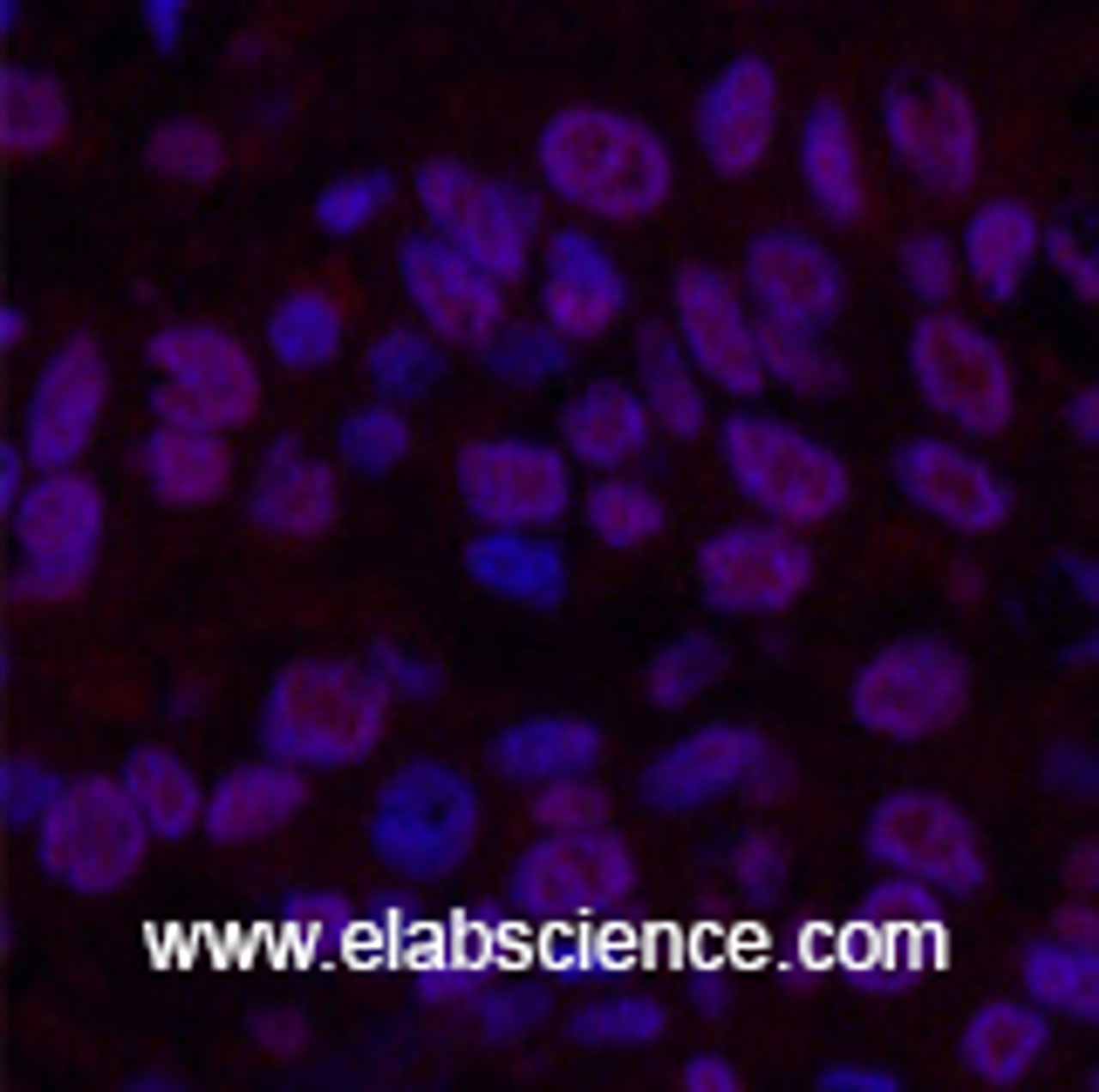Immunofluorescence analysis of Human lung cancer tissue using Transferrin Monoclonal Antibody at dilution of 1:200.