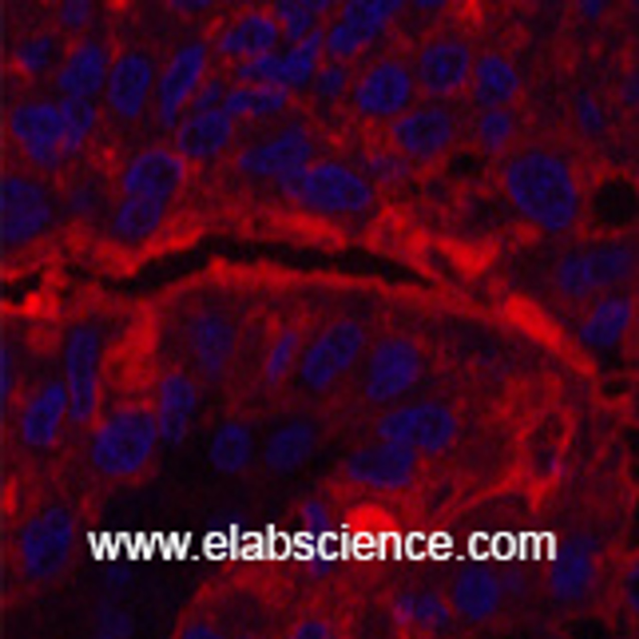 Immunofluorescence analysis of Human liver cancer tissue using CD15 Monoclonal Antibody at dilution of 1:200.