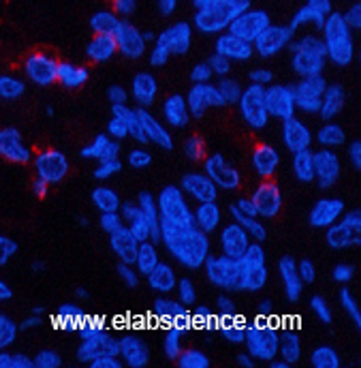 Immunofluorescence analysis of Human lung cancer tissue using LTF Monoclonal Antibody at dilution of 1:200.