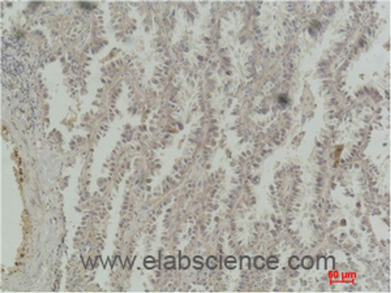 Immunohistochemistry of paraffin-embedded Human lung carcinoma tissue with CREB1 Monoclonal Antibody