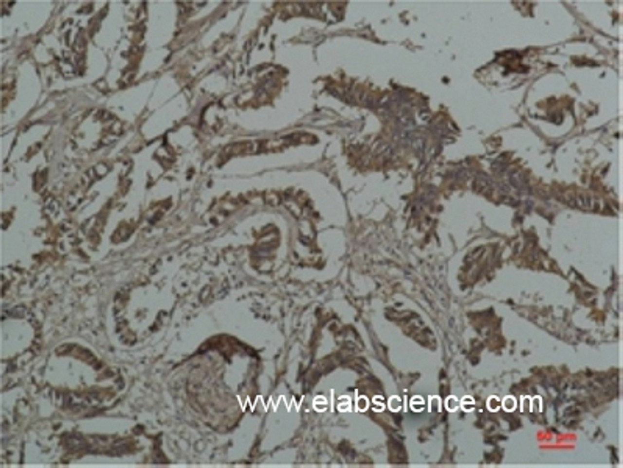 Immunohistochemistry of paraffin-embedded Human breast carcinoma tissue using HSP27 Monoclonal Antibody at dilution of 1:200.