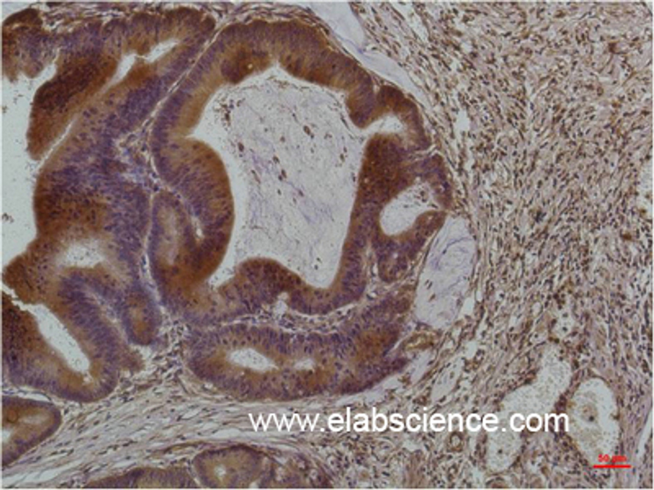 Immunohistochemistry of paraffin-embedded Human colon carcinoma tissue using Smad3 Monoclonal Antibody at dilution of 1:200.
