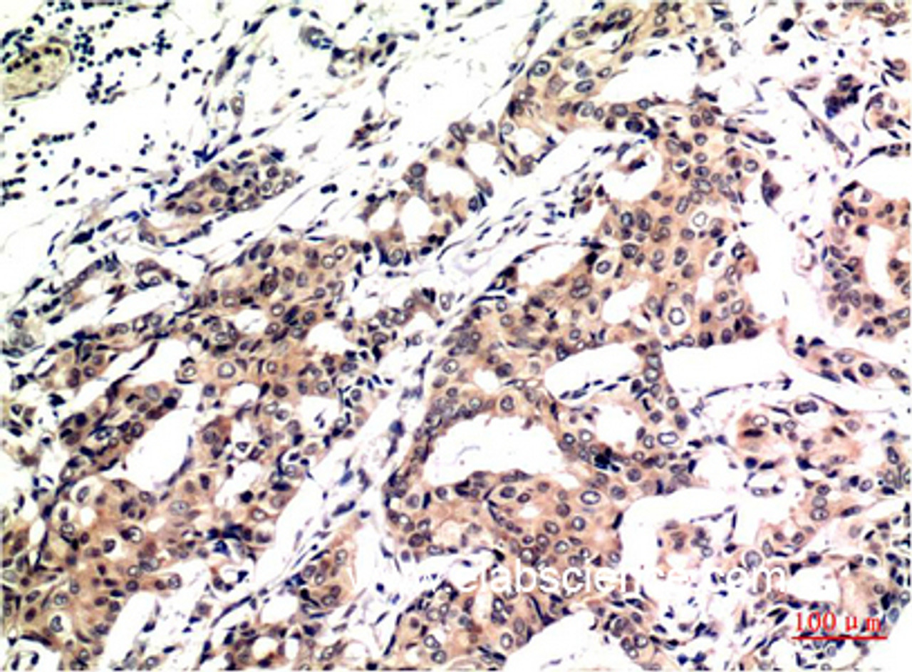 Immunohistochemistry of paraffin-embedded Human breast carcinoma  tissue using Ubiquitin Monoclonal Antibody at dilution of 1:200.