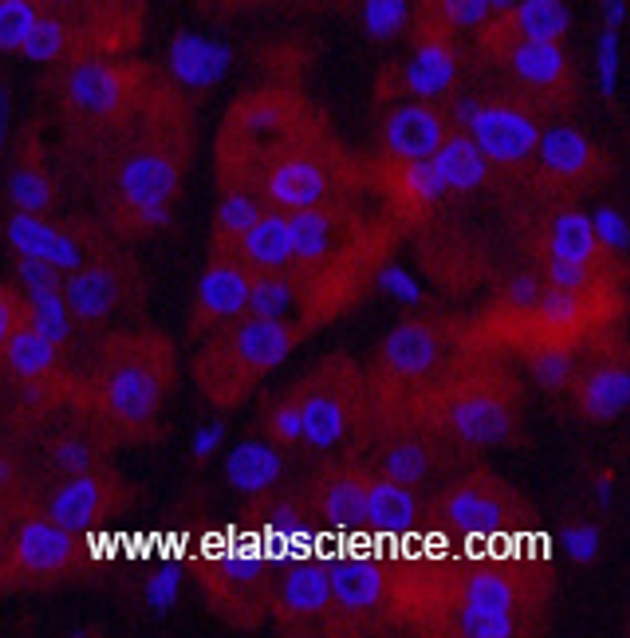 Immunofluorescence analysis of Human stomach cancer tissue using Ubiquitin Monoclonal Antibody at dilution of 1:200.