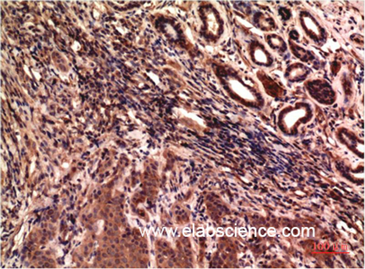 Immunohistochemistry of paraffin-embedded Human breast carcinoma tissue using gamma Tubulin Monoclonal Antibody at dilution of 1:200.