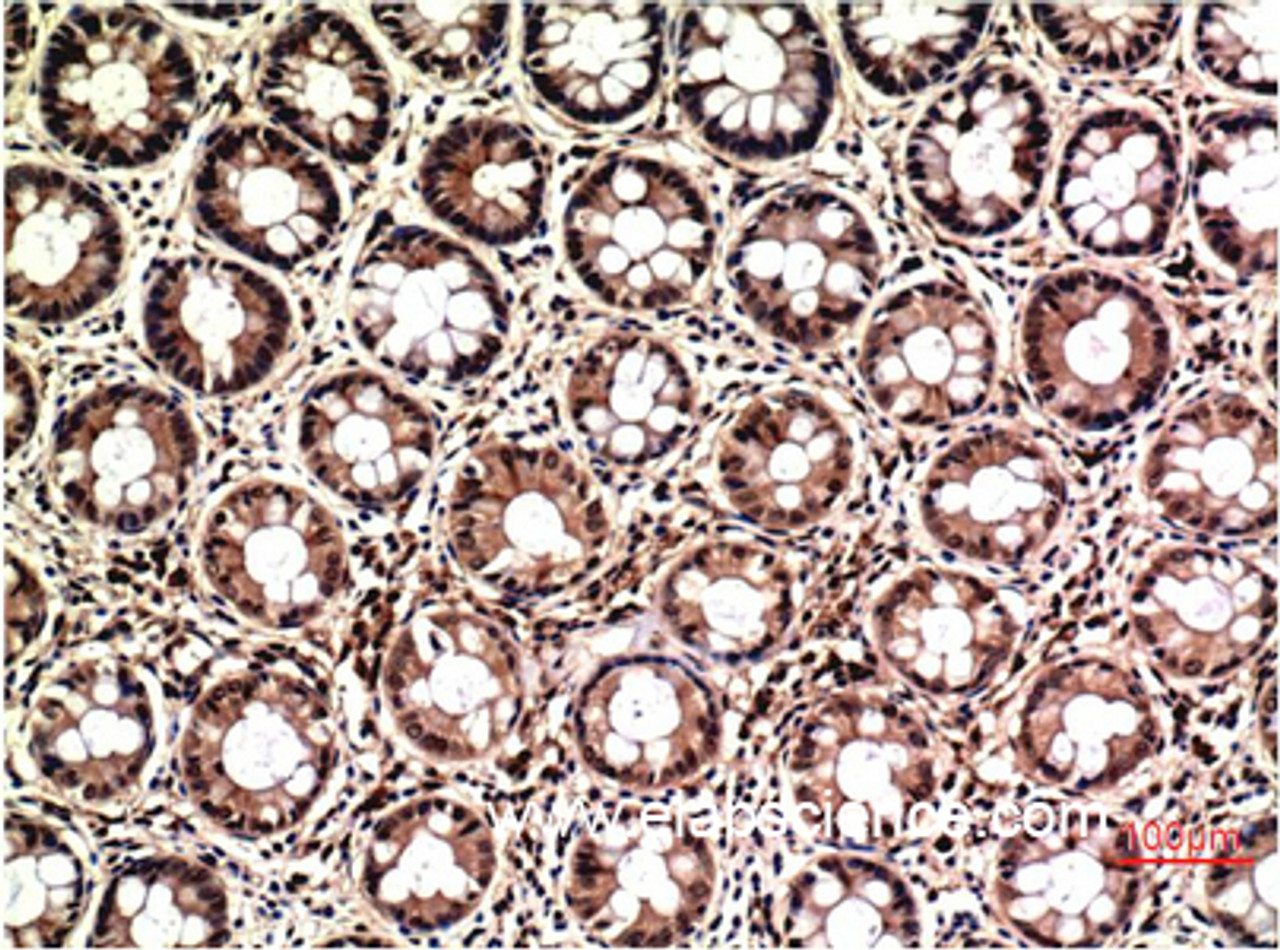 Immunohistochemistry of paraffin-embedded Human colon carcinoma tissue using ERK 1/2 Monoclonal Antibody at dilution of 1:200.