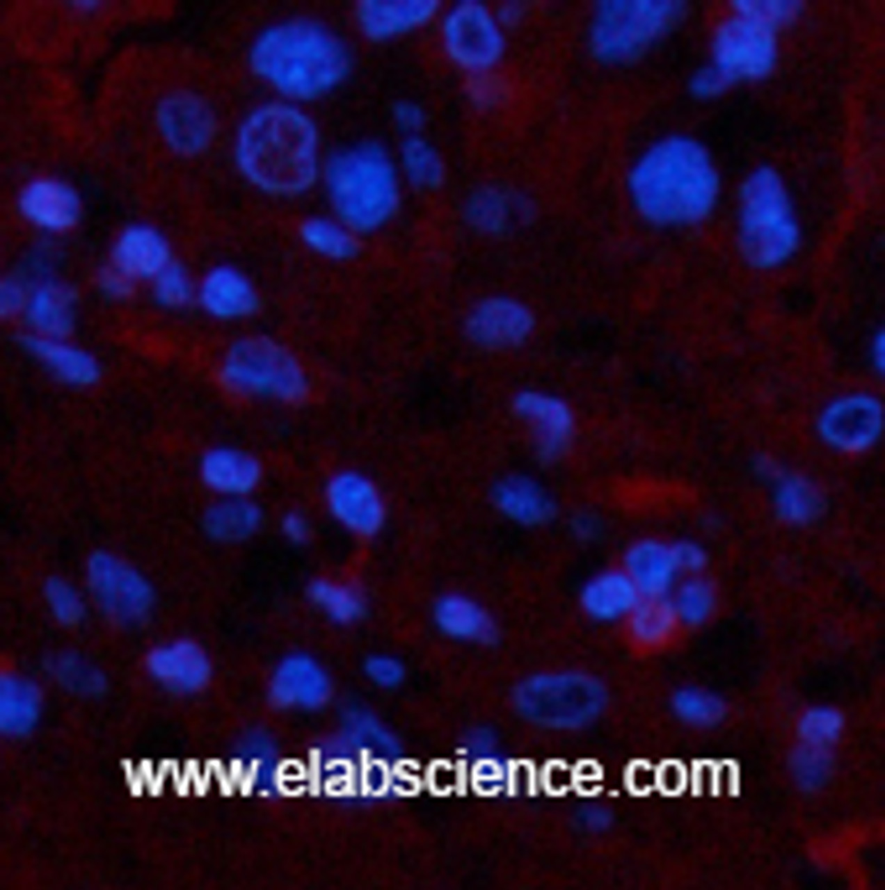 Immunofluorescence analysis of Human liver cancer tissue using TTR Monoclonal Antibody at dilution of 1:200.