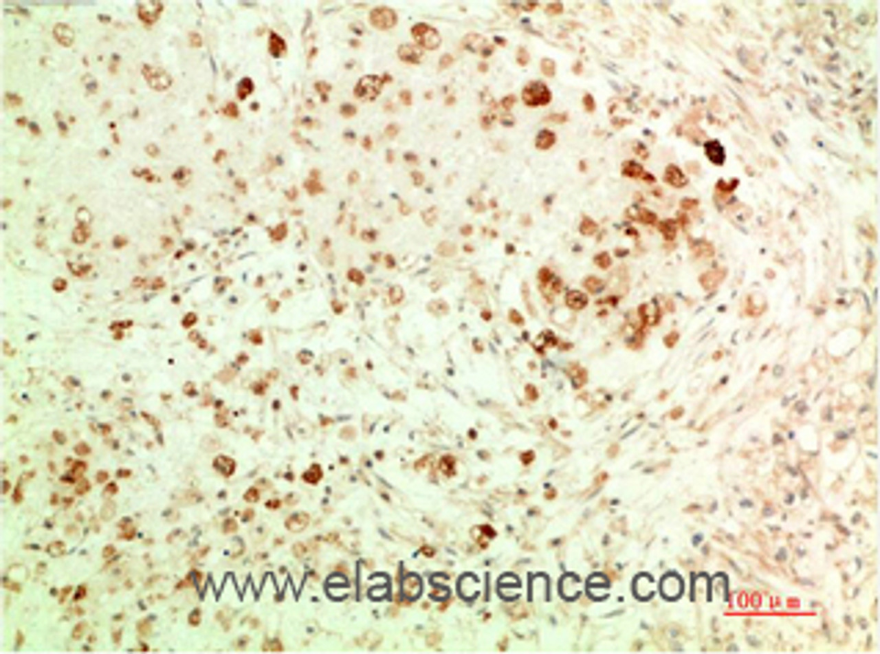 Immunohistochemistry of paraffin-embedded Human ovarian carcinoma tissue using ATG5 Monoclonal Antibody at dilution of 1:200.