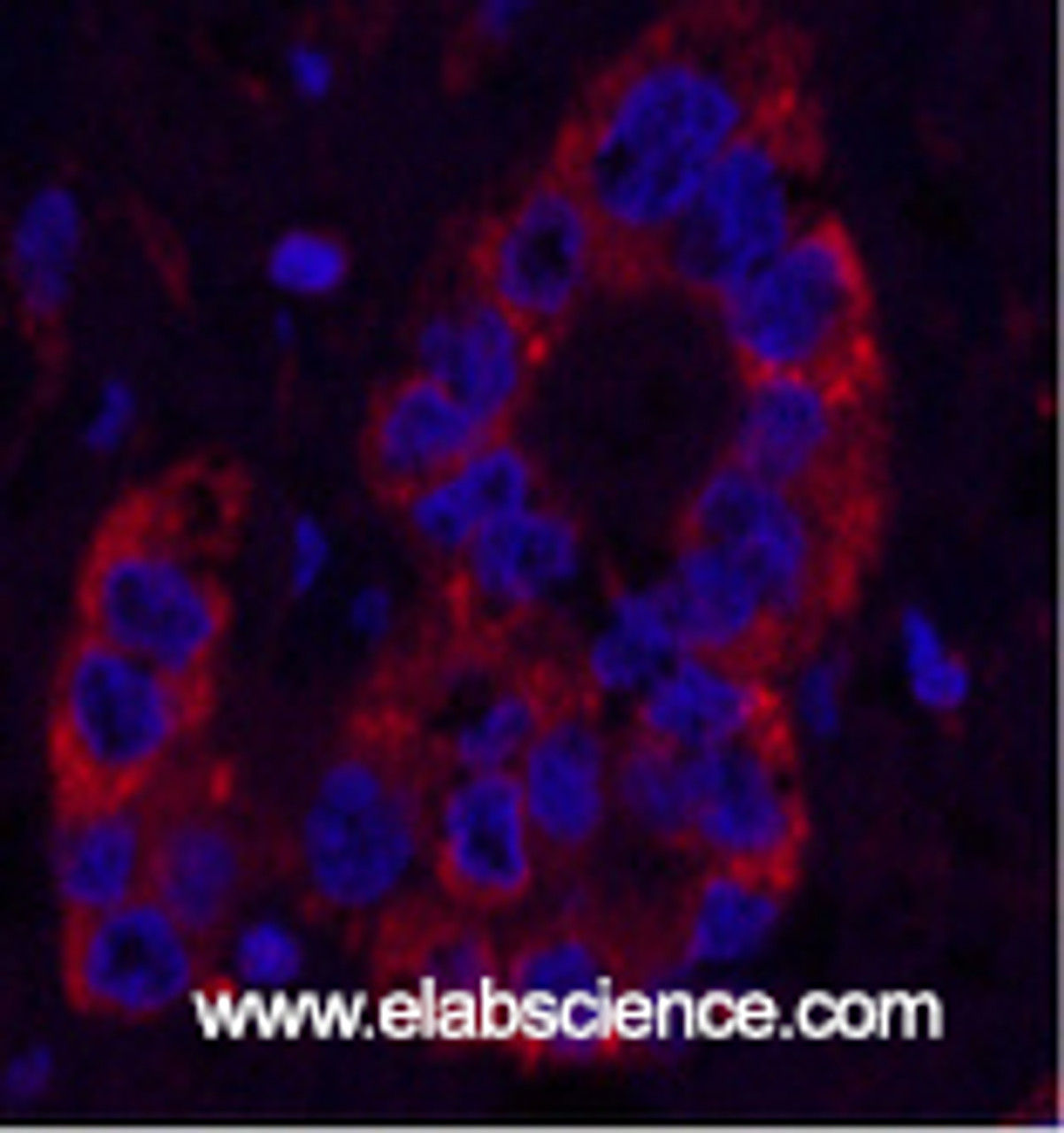 Immunofluorescence analysis of Human liver cancer tissue using NFKBIB Monoclonal Antibody at dilution of 1:200.