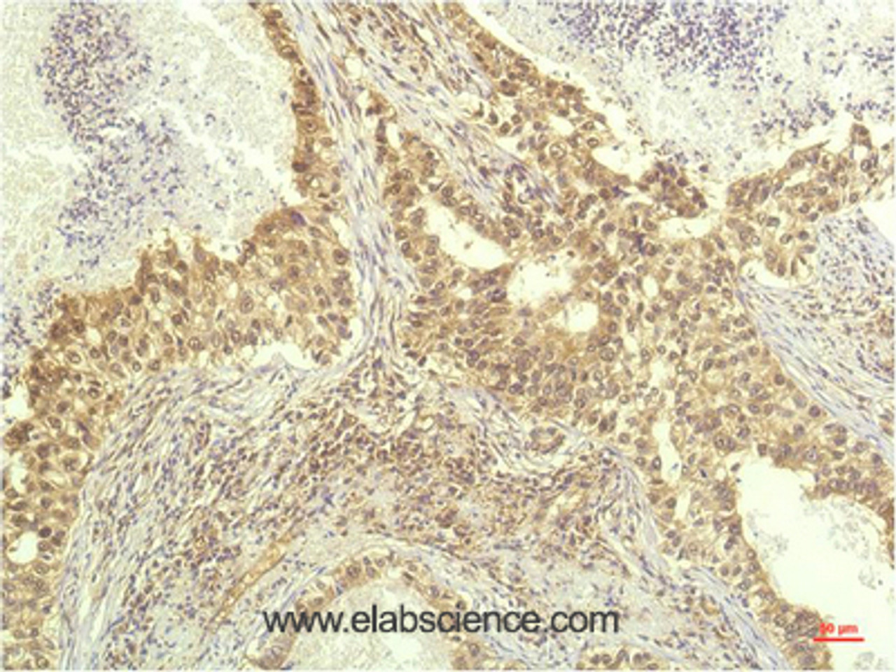 Immunohistochemistry of paraffin-embedded Human lung carcinoma tissue using p70 S6 kinase alpha Monoclonal Antibody at dilution of 1:200.