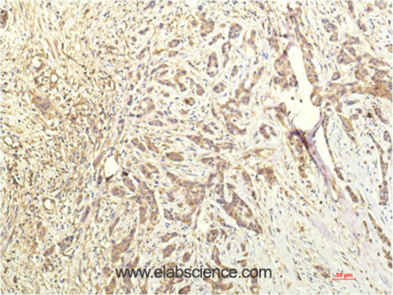 Immunohistochemistry of paraffin-embedded Human breast carcinoma tissue using STAT1 Monoclonal Antibody at dilution of 1:200.