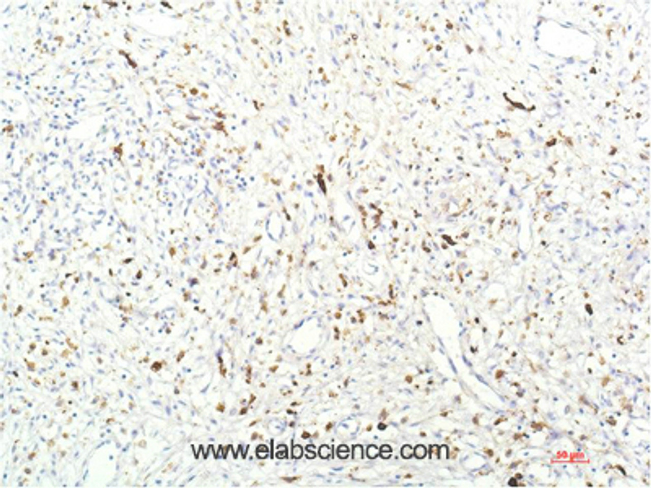 Immunohistochemistry of paraffin-embedded Human breast carcinoma tissue using JAK1 Monoclonal Antibody at dilution of 1:200.