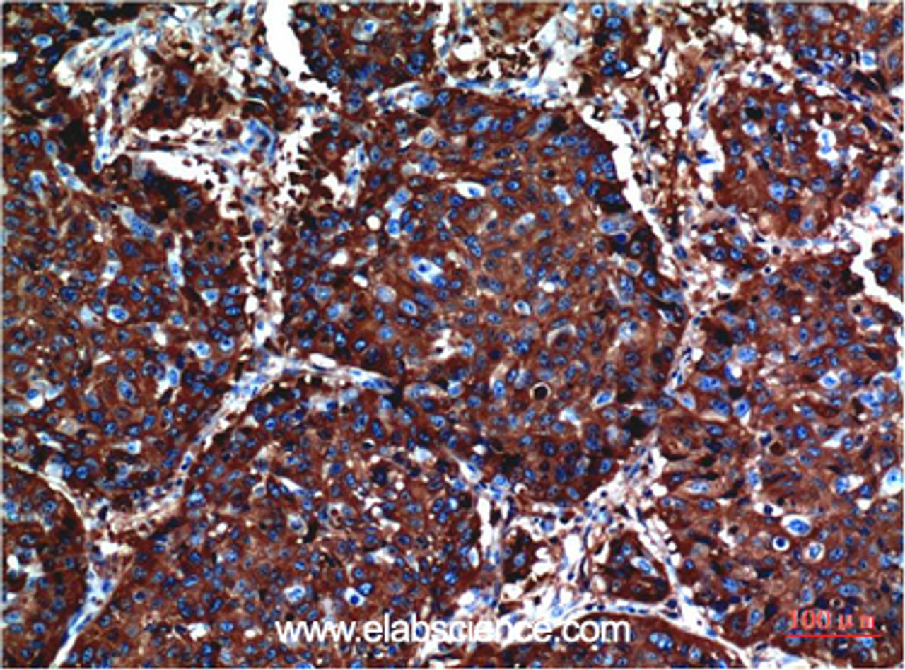 Immunohistochemistry of paraffin-embedded Human lung carcinoma tissue using AKT1 Monoclonal Antibody at dilution of 1:200.