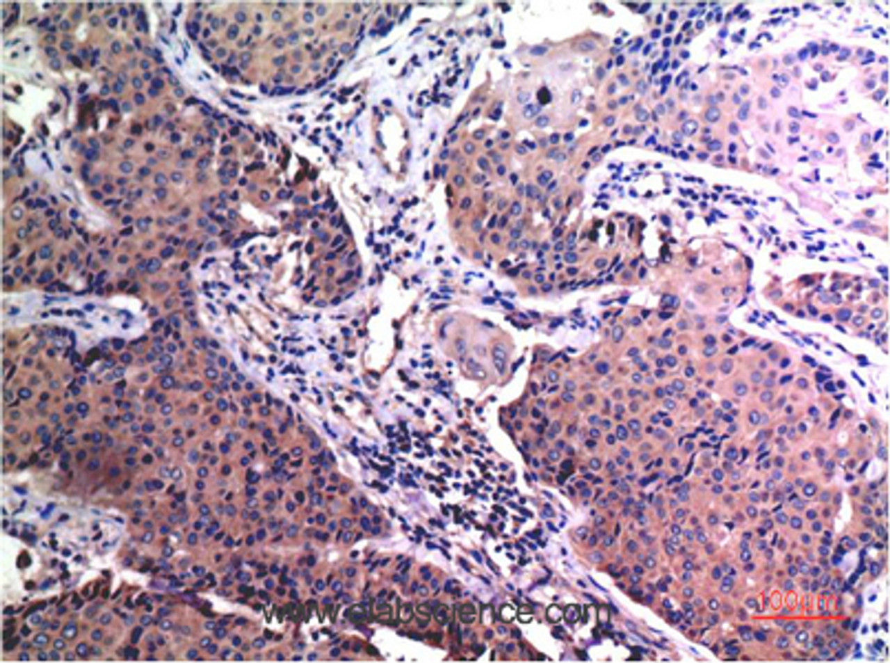 Immunohistochemistry of paraffin-embedded Human breast carcinoma tissue using MMP2 Monoclonal Antibody at dilution of 1:200.
