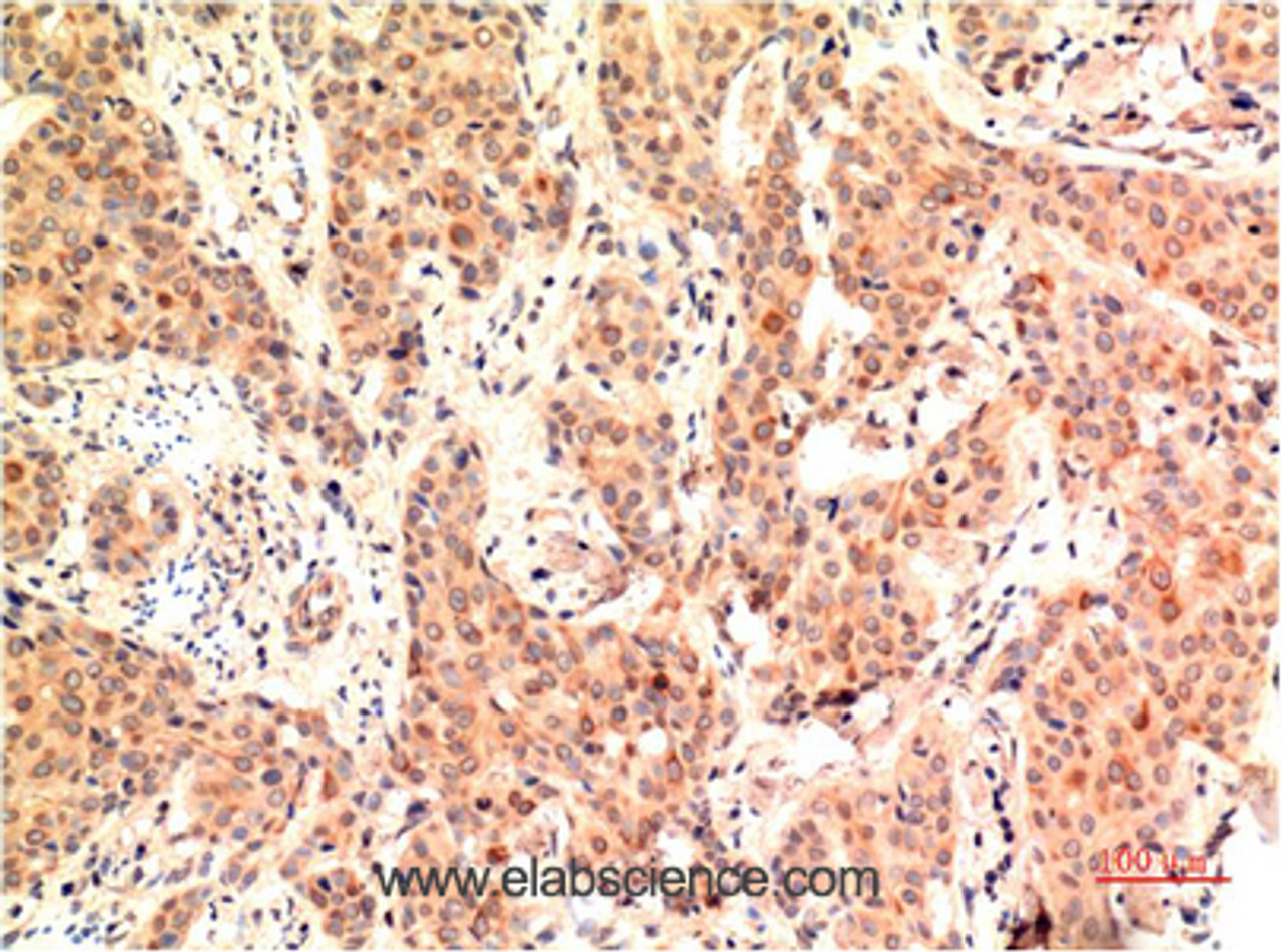 Immunohistochemistry of paraffin-embedded Human breast carcinoma tissue using ERK 1 Monoclonal Antibody at dilution of 1:200.