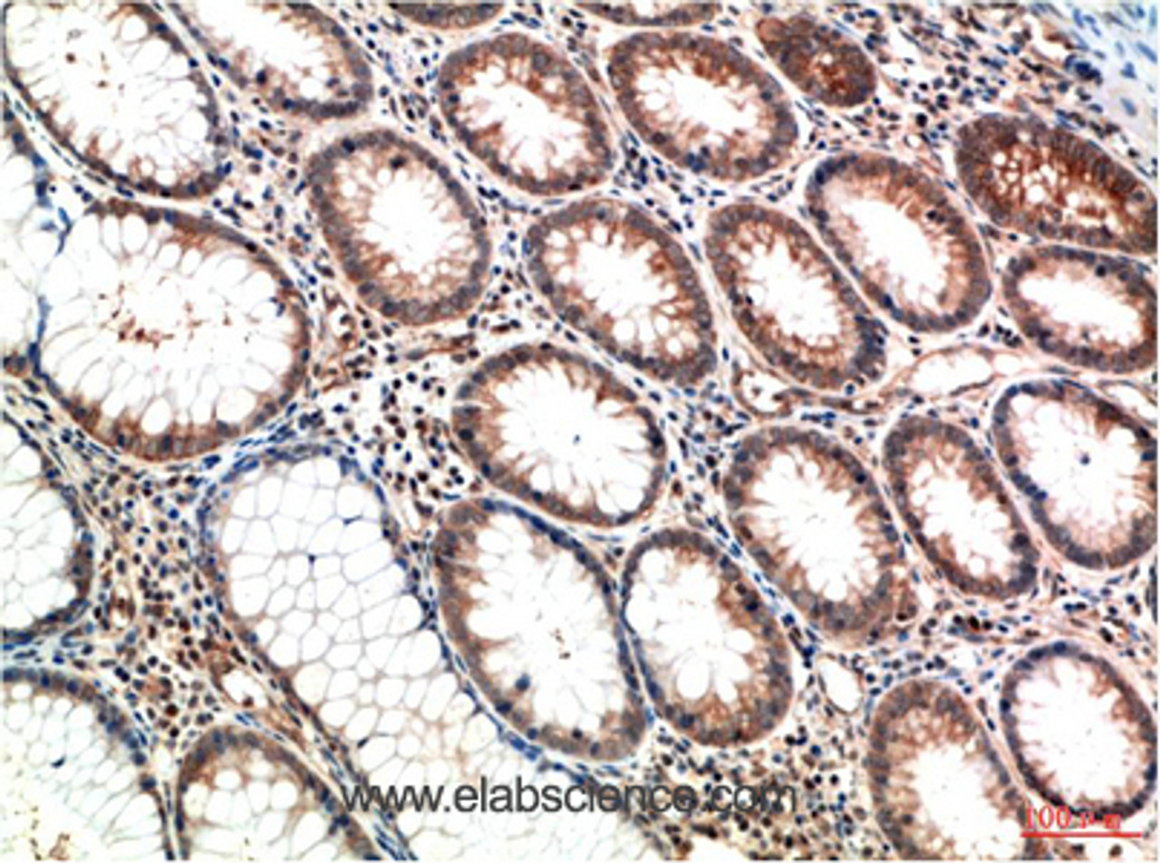 Immunohistochemistry of paraffin-embedded Human colon carcinoma tissue using ATM Monoclonal Antibody at dilution of 1:200.