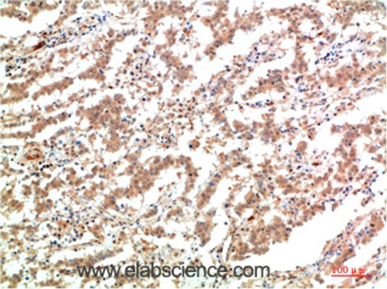 Immunohistochemistry of paraffin-embedded Human lung carcinoma tissue using JAK2 Monoclonal Antibody at dilution of 1:200.