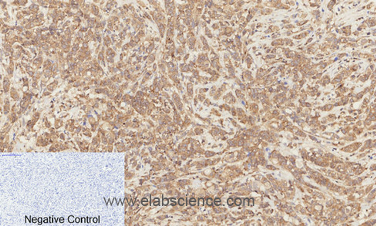 Immunohistochemistry of paraffin-embedded Human breast cancer tissue  using Phospho-Catenin beta (Ser37) Polyclonal Antibody at dilution of 1:200