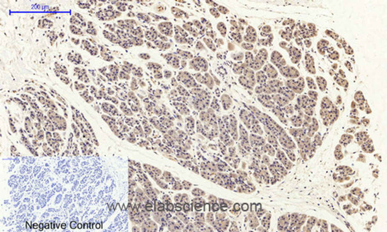 Immunohistochemistry of paraffin-embedded Human stomach cancer tissue with Phospho-FAK (Tyr397) Polyclonal Antibody at dilution of 1:200