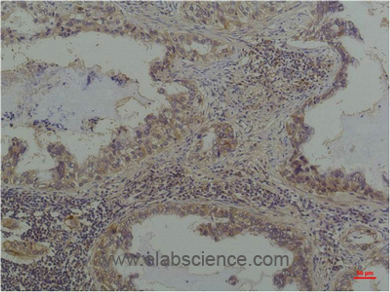 Immunohistochemistry of paraffin-embedded Human lung carcinoma tissue with Phosphoserine Monoclonal Antibody at dilution of 1:200