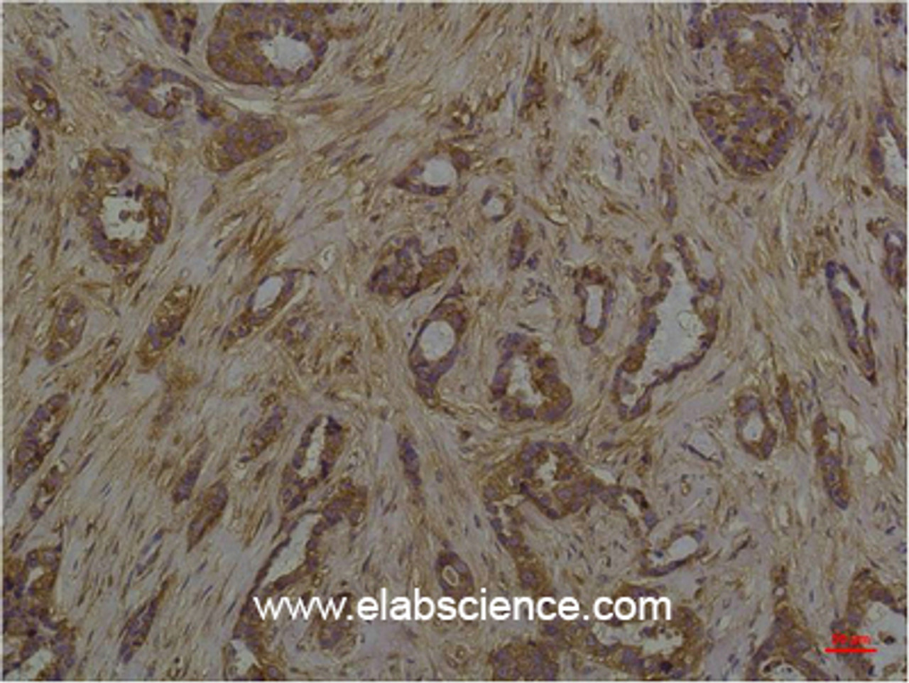 Immunohistochemistry of paraffin-embedded Human breast carcinoma tissue with Phosphoserine Monoclonal Antibody at dilution of 1:200