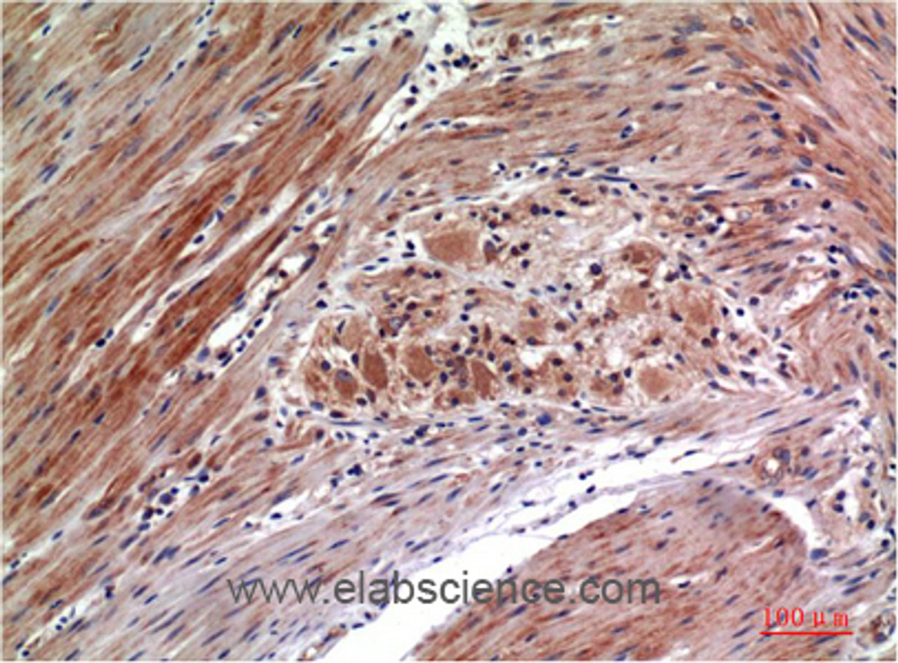 Immunohistochemistry of paraffin-embedded Human colon carcinoma tissue with Phospho-ERK 1/2 (Tyr222/205) Monoclonal Antibody at dilution of 1:200