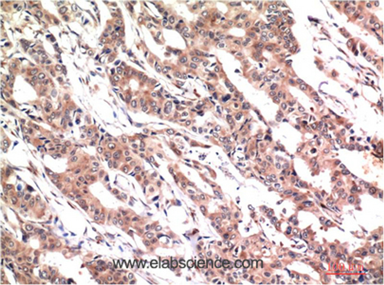Immunohistochemistry of paraffin-embedded Human colon carcinoma tissue using Phospho-STAT3 (Tyr705) Monoclonal Antibody at dilution of 1:200.