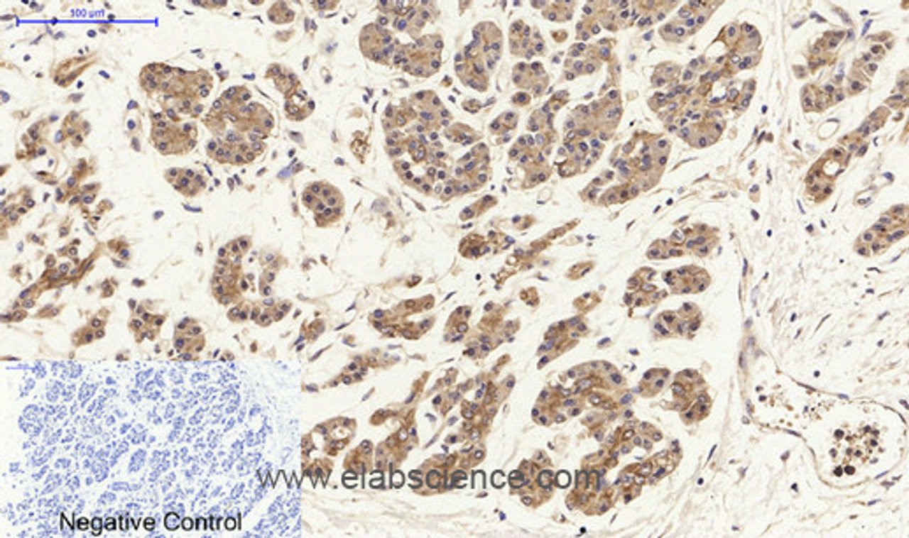 Immunohistochemistry of paraffin-embedded Human stomach cancer tissue using HSP27 Polyclonal Antibody at dilution of 1:200.
