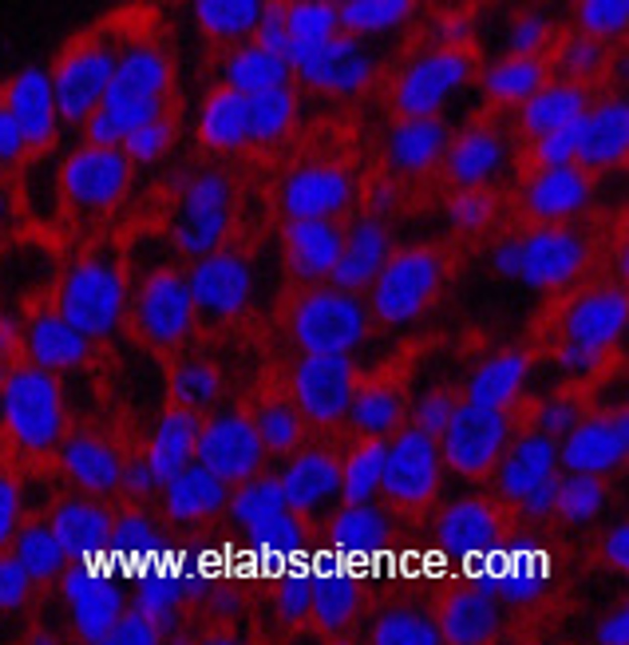 Immunofluorescence analysis of Human liver cancer tissue using Cleaved-CASP3 p12 (D175) Polyclonal Antibody at dilution of 1:200.