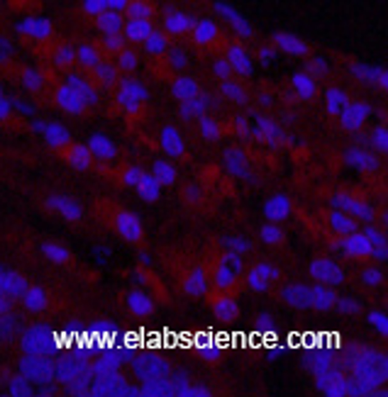 Immunofluorescence analysis of Human lung cancer tissue using Cleaved-NOTCH1 (V1754) Polyclonal Antibody at dilution of 1:200.